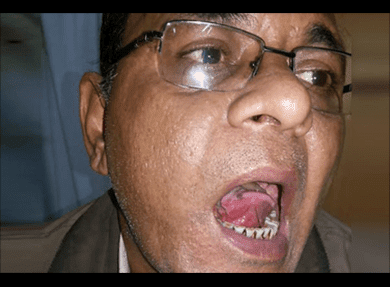 In 9 months of Immunotherapy Tongue  Cancer completely healed